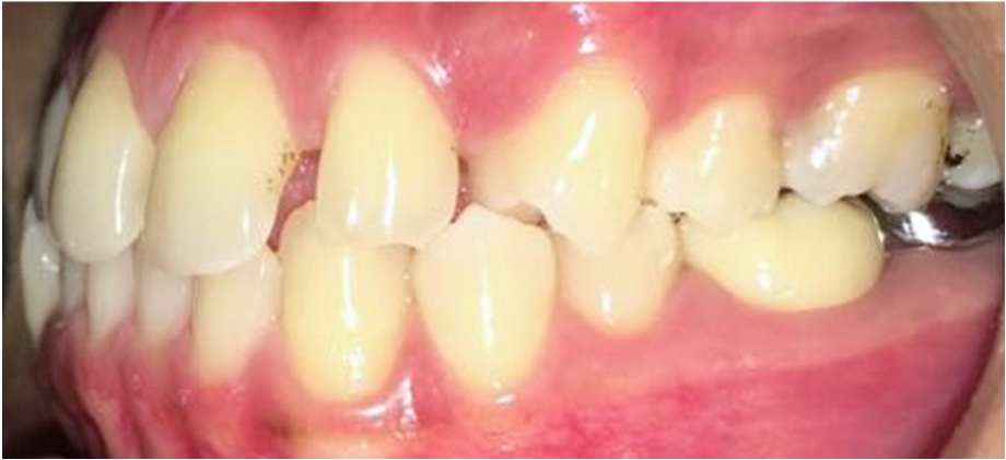 Impacted Canine - Before